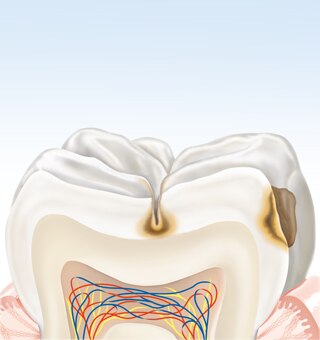 Caries Protection